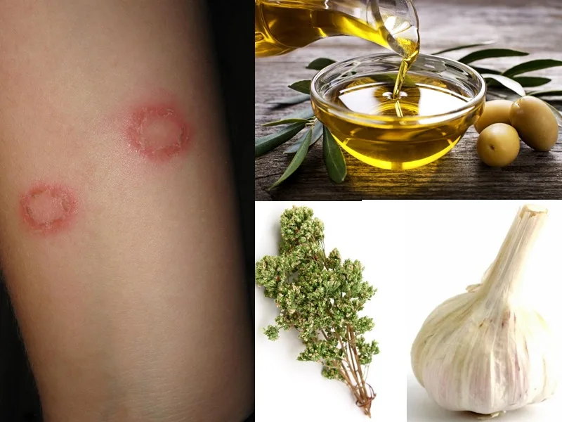 Olio extravergine di oliva usato come rimedio naturale contro la micosi della pelle