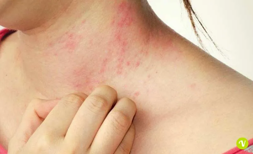 Pelle trattata con olio di oliva come rimedio naturale contro la psoriasi