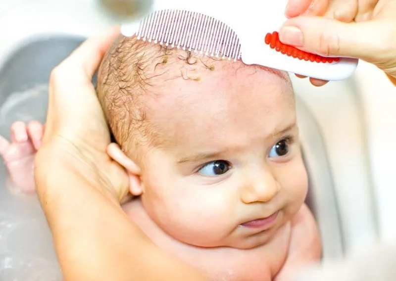 Neonato con crosta lattea sul cuoio capelluto, trattamento con olio extravergine di oliva
