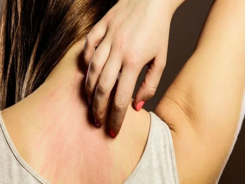 Bottiglia di olio extravergine di oliva usato come rimedio naturale per la pelle irritata dall'orticaria