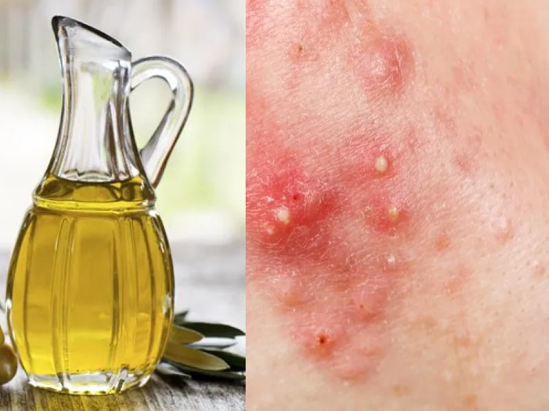 Bottiglia di olio extravergine di oliva usato come rimedio naturale contro la follicolite depilatoria