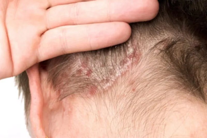 Goccia di olio extravergine di oliva usata come rimedio naturale per la dermatite seborroica